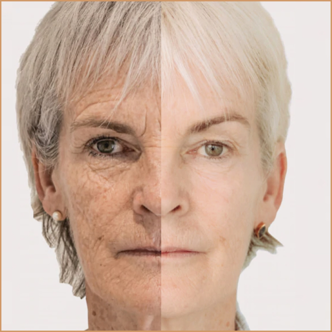 Morpheus 8: All you need to know about Judy Murray’s facelift A non-invasive treatment.